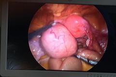 how they look....fibroids... all around the uterus..