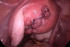 uterus stitched back..