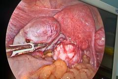 fibroids...all around..!