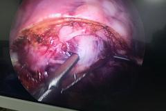 laparoscopic fibroid removals...